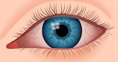 Consejos para aliviar los síntomas del ojo seco - Clínica Ojo Seco